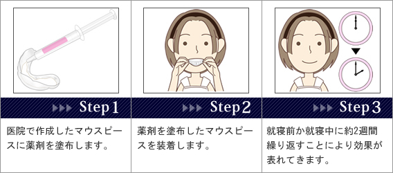 医院で作成したマウスピースに薬剤を塗布します。→薬剤を塗布したマウスピースを装着します。→就寝前か就寝中に約2週間繰り返すことにより効果が表れてきます。